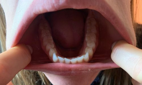 Bottom of Teeth
